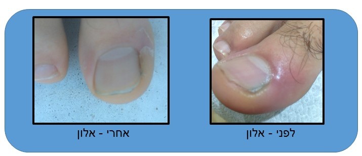 תמונה של ציפורן חודרנית לפני ואחרי תמונה של ציפורן חודרנית לפני ואחרי